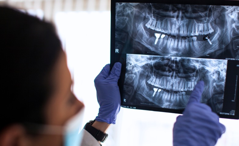 Ortopantomografia digitale 2D