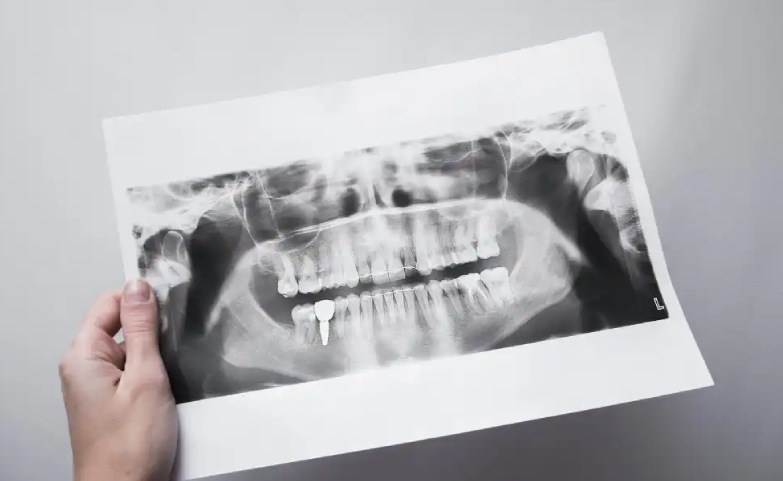 RX endorale ad alta definizione