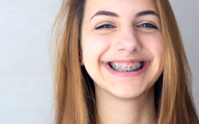 Denti storti: quali tipi di apparecchi ortodontici si possono utilizzare?