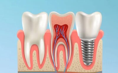 L’inserimento di un impianto dentale fa male?