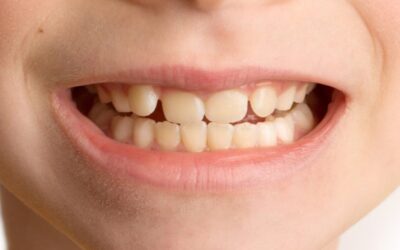 Quali malocclusioni è importante intercettare precocemente?